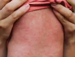 4 Anak Meninggal Akibat Campak di Sumenep, Ratusan Kasus Terjadi Meski Sudah Diimunisasi