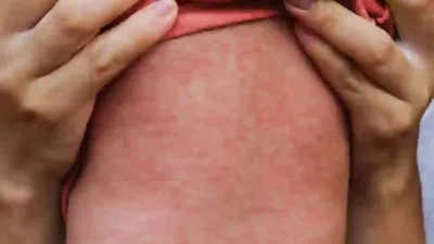 4 Anak Meninggal Akibat Campak di Sumenep, Ratusan Kasus Terjadi Meski Sudah Diimunisasi