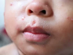 Indonesia Darurat Campak: Peringkat Kedua Dunia, Ribuan Anak Terancam Akibat Hoaks Vaksin!