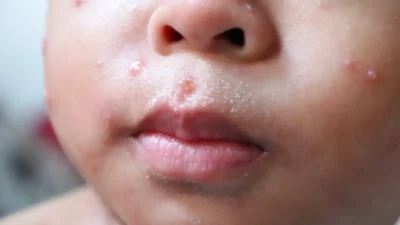 Indonesia Darurat Campak: Peringkat Kedua Dunia, Ribuan Anak Terancam Akibat Hoaks Vaksin!