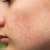Terungkap! Rahasia Alami Basmi Wajah Beruntusan, Kulit Mulus Bebas Khawatir