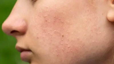 Terungkap! Rahasia Alami Basmi Wajah Beruntusan, Kulit Mulus Bebas Khawatir